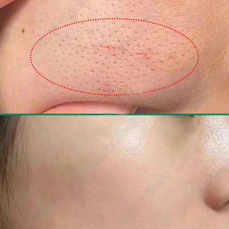 Salicylic Acid Pore Clearing Cream