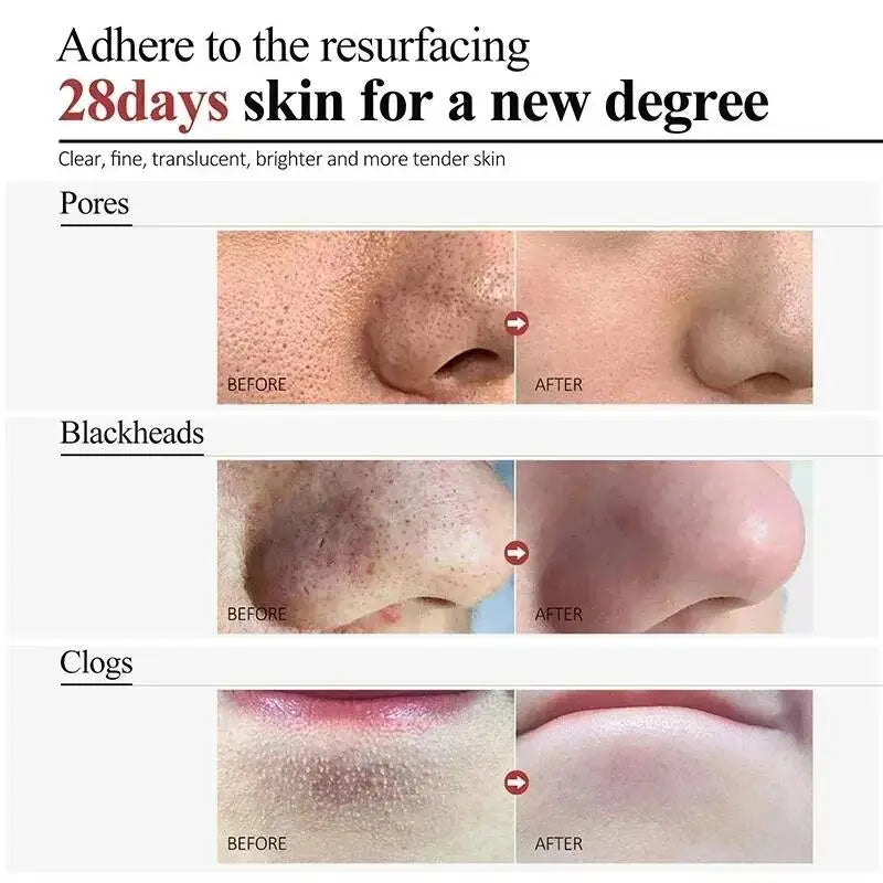 Salicylic Acid Pore Clearing Cream