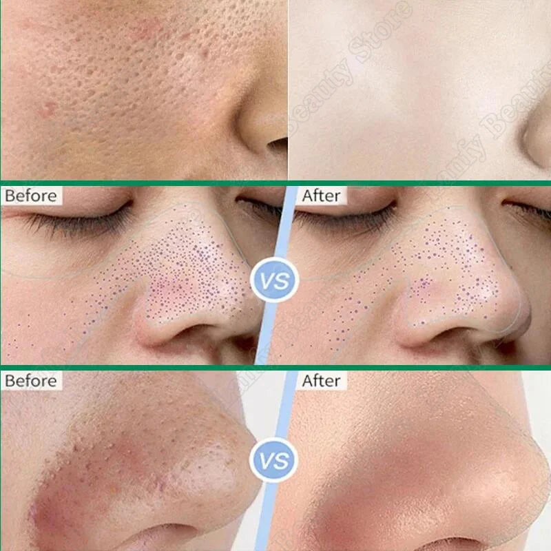 Salicylic Acid Pore Clearing Cream