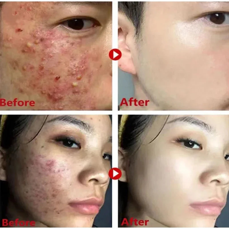 Green Tea Blackhead Removal Face Stick