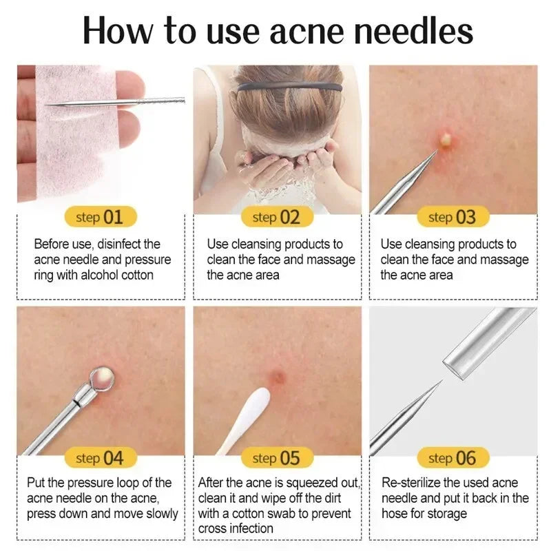 1/11Pcs Blackhead & Acne Remover Tool Set – Tweezers & Extractor Kit