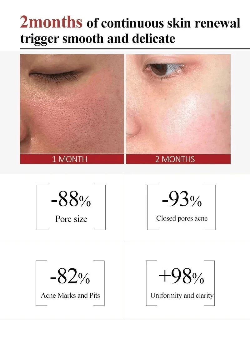 Salicylic Acid Pore Clearing Cream