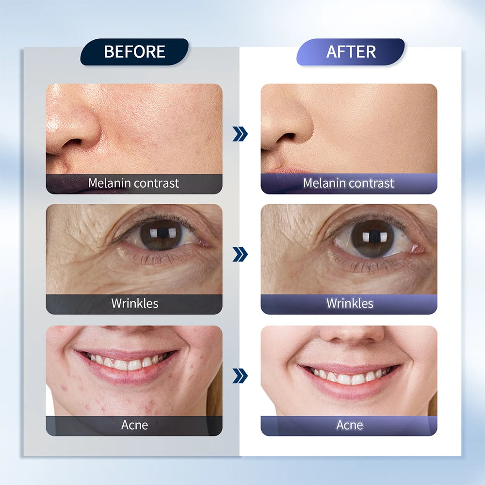 Foreverlily LED Face Mask PDT Machine – 7-Color Photon Therapy with Nano Spray